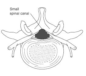 Spinal stenosis (small spinal canal)
